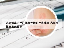 大腿根出了一片像癣一样的一直痒痒 大腿根起癣怎么回事