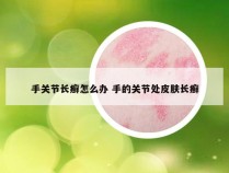 手关节长癣怎么办 手的关节处皮肤长癣