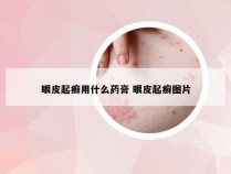 眼皮起癣用什么药膏 眼皮起癣图片