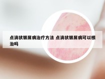 点滴状银屑病治疗方法 点滴状银屑病可以根治吗