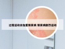 过度运动会加重银屑病 银屑病剧烈运动