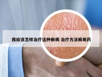 我应该怎样治疗这种癣病 治疗方法癣用药