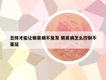 怎样才能让银屑病不复发 银屑病怎么控制不蔓延