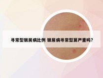 寻常型银屑病比例 银屑病寻常型算严重吗?