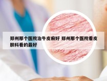 郑州那个医院治牛皮癣好 郑州那个医院看皮肤科看的最好