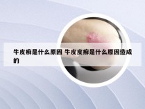 牛皮癣是什么原因 牛皮皮癣是什么原因造成的