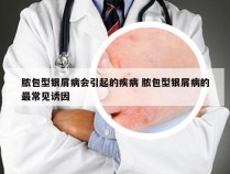 脓包型银屑病会引起的疾病 脓包型银屑病的最常见诱因