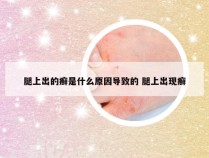 腿上出的癣是什么原因导致的 腿上出现癣