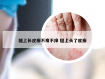 腿上长皮癣不痛不痒 腿上长了皮癣