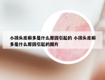 小孩头皮癣多是什么原因引起的 小孩头皮癣多是什么原因引起的图片