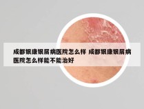 成都银康银屑病医院怎么样 成都银康银屑病医院怎么样能不能治好