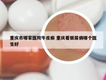 重庆市哪家医院牛皮癣 重庆看银屑病哪个医生好