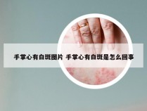 手掌心有白斑图片 手掌心有白斑是怎么回事