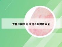 大腿长癣图片 大腿长癣图片大全