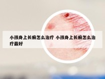 小孩身上长癣怎么治疗 小孩身上长癣怎么治疗最好