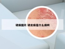 硬癣图片 硬皮癣是什么病啊