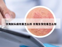 华夷制头癣效果怎么样 华夷生发效果怎么样