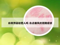 白斑传染给他人吗 白点癫风的初期症状