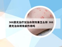 308激光治疗仪治白斑效果怎么样 308激光治白斑有副作用吗