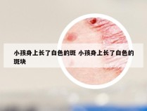 小孩身上长了白色的斑 小孩身上长了白色的斑块