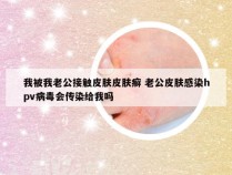 我被我老公接触皮肤皮肤癣 老公皮肤感染hpv病毒会传染给我吗