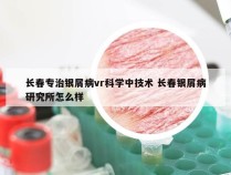 长春专治银屑病vr科学中技术 长春银屑病研究所怎么样