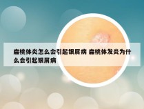 扁桃体炎怎么会引起银屑病 扁桃体发炎为什么会引起银屑病