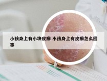 小孩身上有小块皮癣 小孩身上有皮癣怎么回事