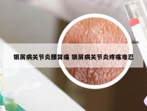 银屑病关节炎腰背痛 银屑病关节炎疼痛难忍