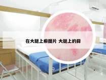 在大腿上癣图片 大腿上的藓