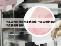 什么生物制剂治疗皮肤瘙痒 什么生物制剂治疗皮肤瘙痒最好