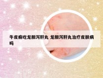 牛皮癣吃龙胆泻肝丸 龙胆泻肝丸治疗皮肤病吗