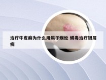 治疗牛皮癣为什么用蝎子蜈蚣 蝎毒治疗银屑病