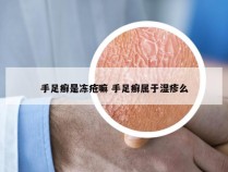 手足癣是冻疮嘛 手足癣属于湿疹么