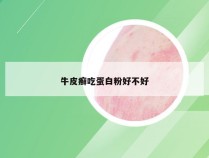 牛皮癣吃蛋白粉好不好