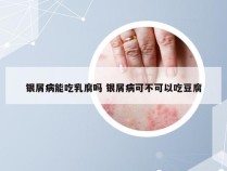 银屑病能吃乳腐吗 银屑病可不可以吃豆腐