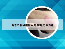 癣怎么传染给别人的 癣是怎么传染