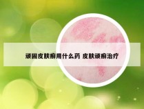 顽固皮肤癣用什么药 皮肤顽癣治疗