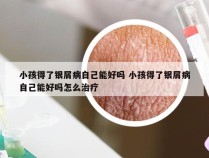 小孩得了银屑病自己能好吗 小孩得了银屑病自己能好吗怎么治疗