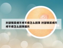 肘部银屑病不疼不痒怎么回事 肘部银屑病不疼不痒怎么回事图片