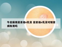 牛皮癣用尿素维e乳膏 尿素维e乳膏对银屑病有用吗