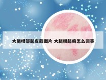 大腿根部起皮藓图片 大腿根起癣怎么回事