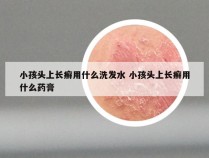 小孩头上长癣用什么洗发水 小孩头上长癣用什么药膏