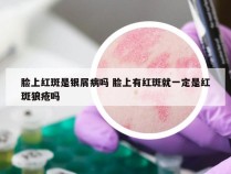 脸上红斑是银屑病吗 脸上有红斑就一定是红斑狼疮吗