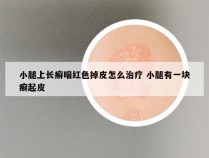 小腿上长癣暗红色掉皮怎么治疗 小腿有一块癣起皮