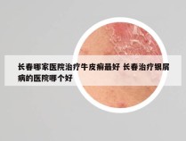 长春哪家医院治疗牛皮癣最好 长春治疗银屑病的医院哪个好