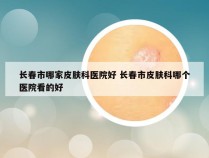 长春市哪家皮肤科医院好 长春市皮肤科哪个医院看的好