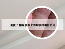 蛋蛋上有癣 蛋蛋上有癣很痒用什么药