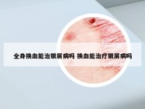 全身换血能治银屑病吗 换血能治疗银屑病吗