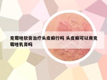 克霉唑软膏治疗头皮癣行吗 头皮癣可以用克霉唑乳膏吗